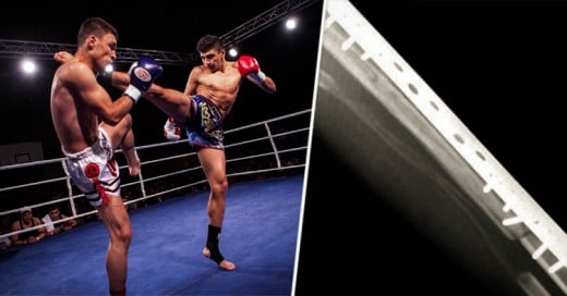 Suspenden a peleador de Muay Thai por luchar varas de Titanio en las espinillas