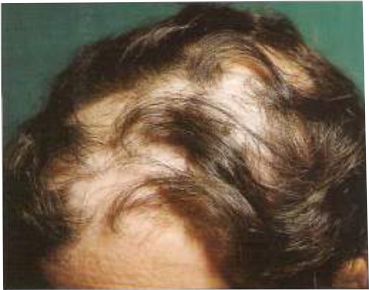 Cabellera con alopecia