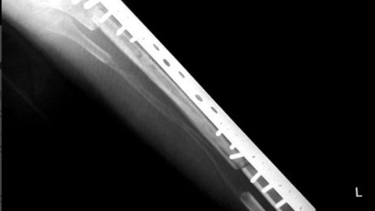 Radiografía de implante de titanio