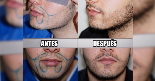 Llegaron los Trasplantes de Barba y se han vuelto una Tendencia creciente