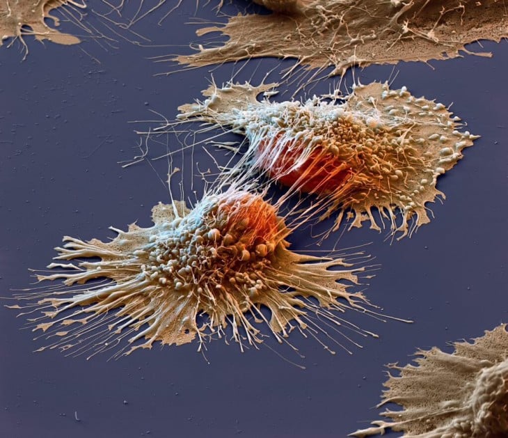 Células de cáncer vistas en microscopio electrónico