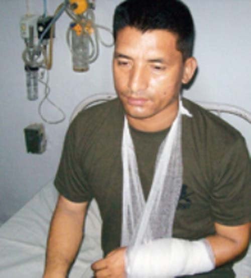 Bishnu Shrestha brazo herido