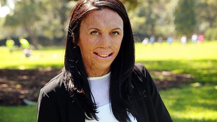 Turia Pitt tuvo quemaduras en todo el cuerpo