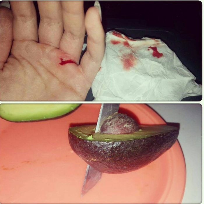 avocado hand 2 heridas por aguacate