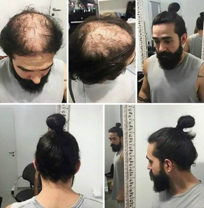 man bun para ocultar la calvicie