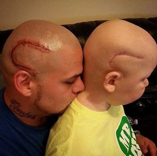 cicatriz niño y papa
