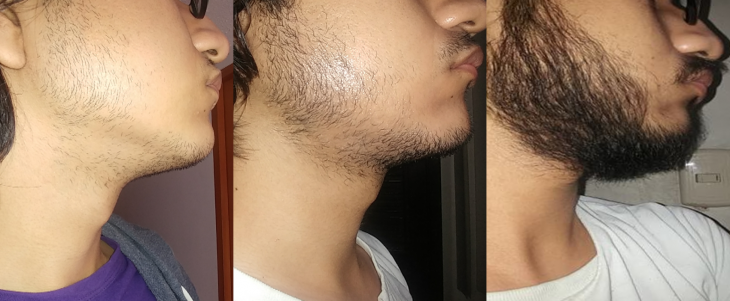barba minoxidil