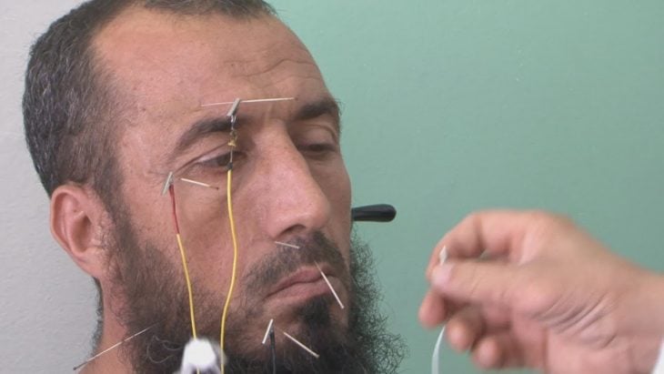 barba acupuntura