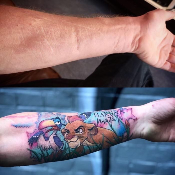 Tatuajes en cicatrices