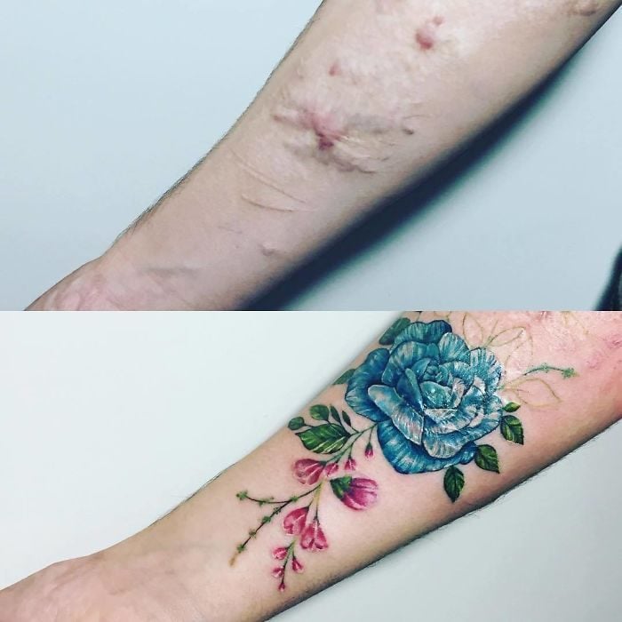 Tatuajes en cicatrices