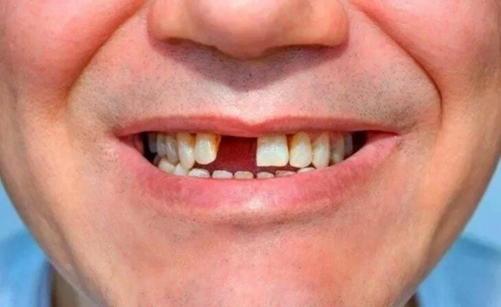 caida de dientes covid