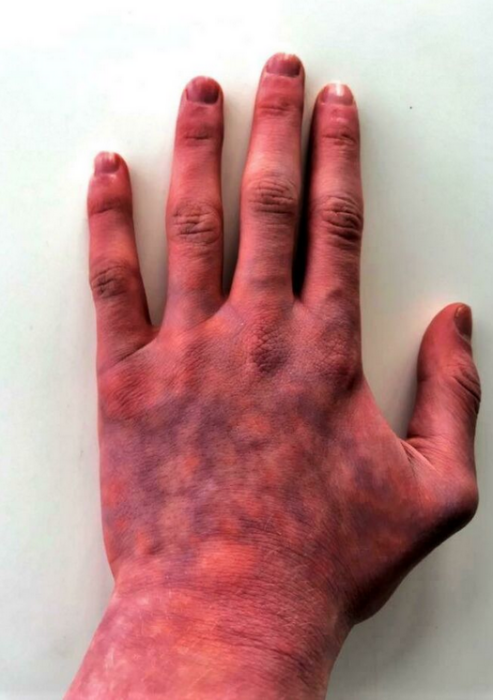 Manos frías síndrome de raynaud