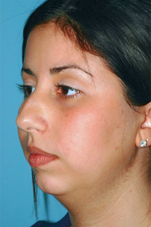 Rinoplastia