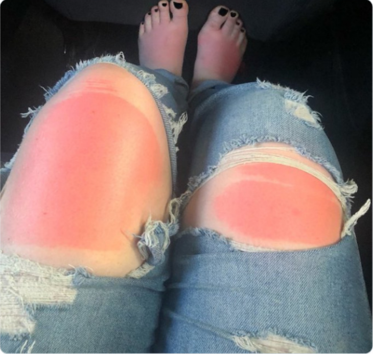 DOlorosas quemaduras de jeans