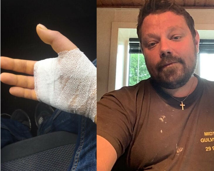 Henrik hombre danés que tuvo la mala suerte de ser mordido por un gato amputaron su dedo índice tras una infección generalizada
